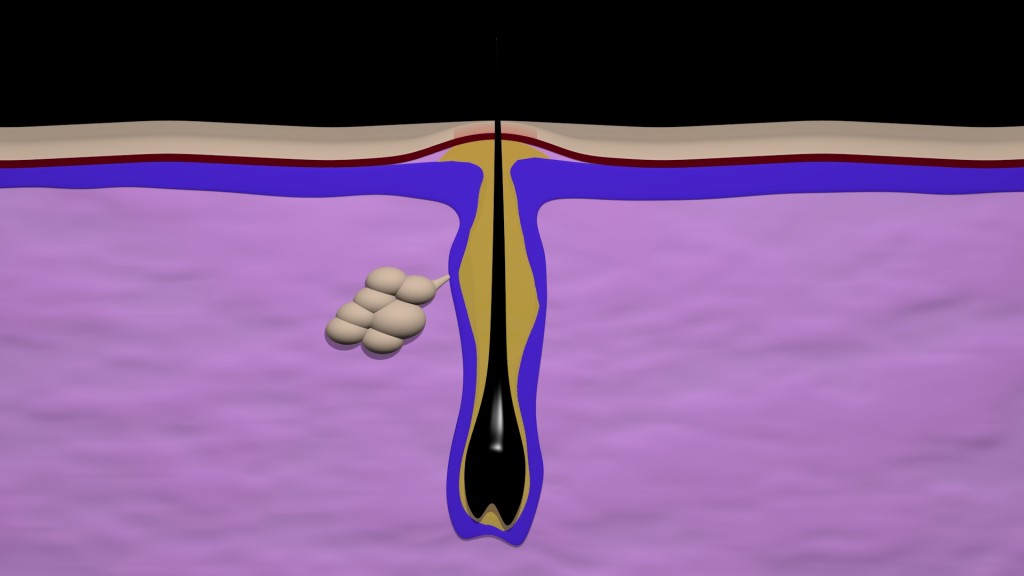Acne formation preview image 2