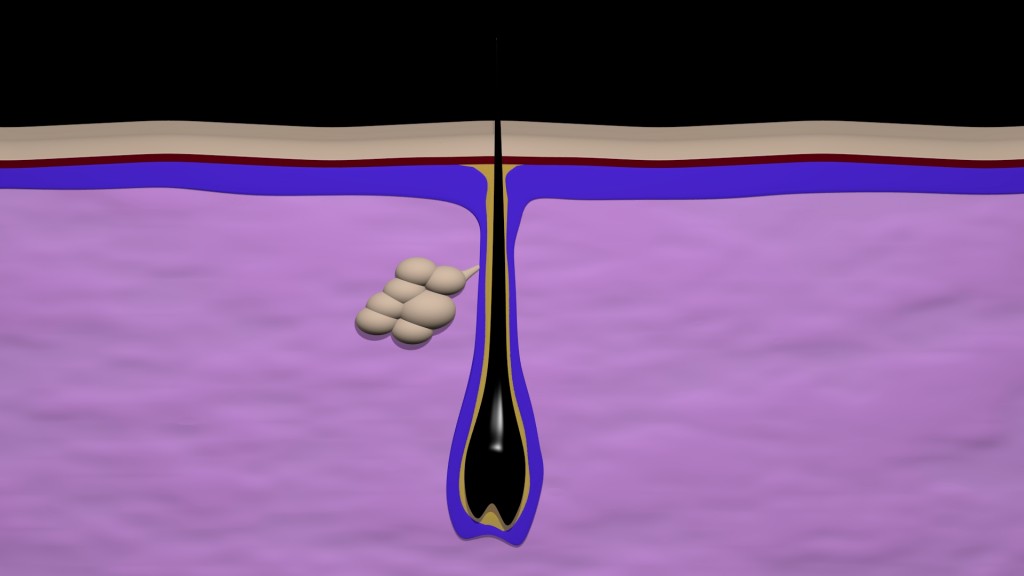 Acne formation preview image 3